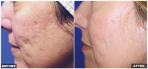 cool beam laser skin resurfacing